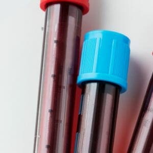 A blood sample in a tube
